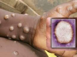 Rare Monkeypox Cases Reported from US, First Time In Nearly 20 Years: All You Need To Know About It